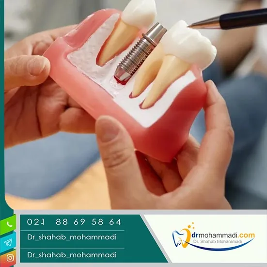 توصیه&zwnj;های قبل و بعد از عمل ایمپلنت